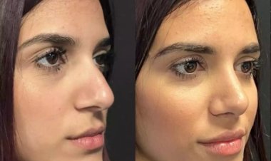 Top Technology Used by the Best Septoplasty Surgeons in Dubai