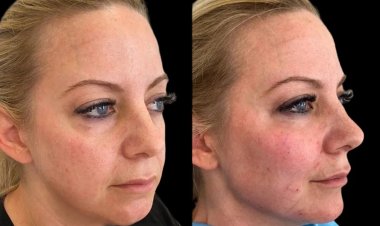 The Best Aesthetic Clinic in Dubai: Experts in Providing Beautiful Cheeks with Cheek Fillers