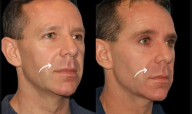 Sculptra Fillers for Post-Weight Loss Contouring at Dubai’s Best Aesthetic Clinics