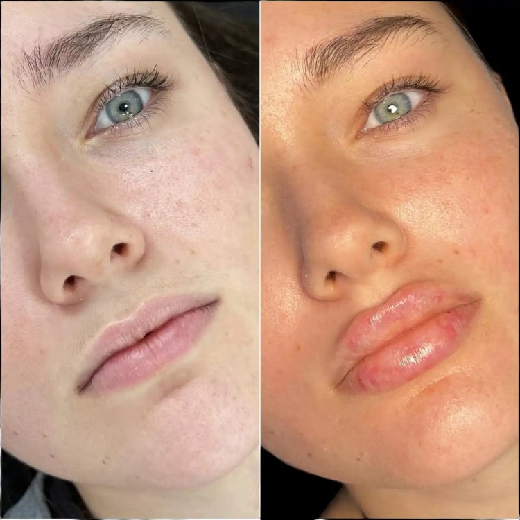 The Russian Lip Fillers Treatment in Dubai: A Step-by-Step Process Explained