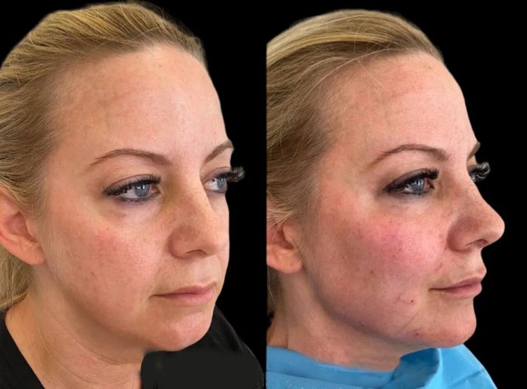 The Best Aesthetic Clinic in Dubai: Experts in Providing Beautiful Cheeks with Cheek Fillers