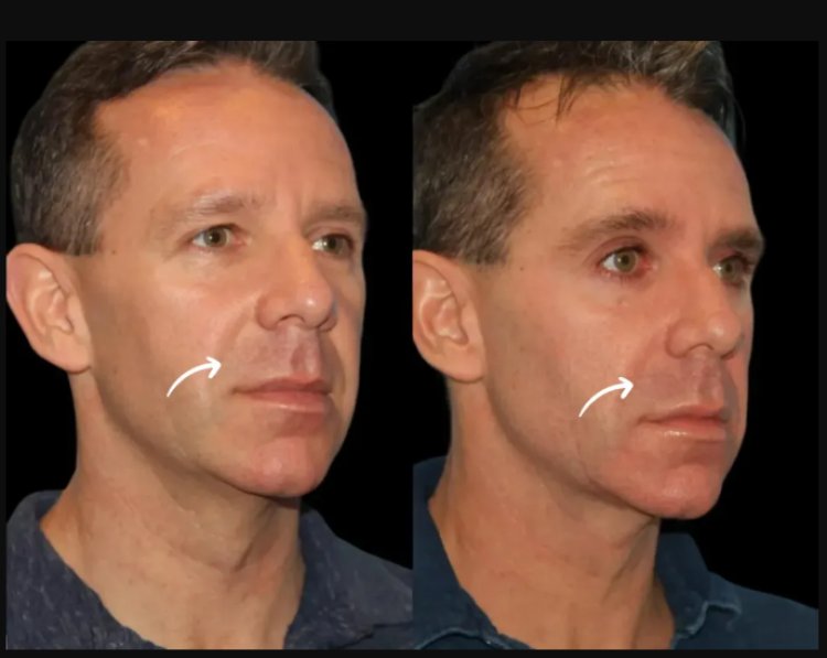 Sculptra Fillers for Post-Weight Loss Contouring at Dubai’s Best Aesthetic Clinics