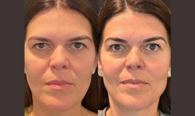 Safety and Side Effects of Getting a Thread Lift in Dubai