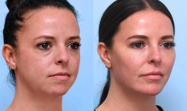 Your Complete Guide to Recovery After Thread Lift in Dubai