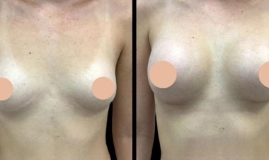 How to Find the Best Breast Enhancement Surgeons in Dubai for Your Budget and Goals