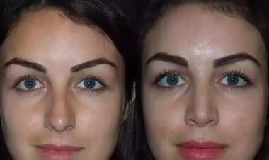 Ethnic Rhinoplasty in Dubai: Respecting and Refining Your Heritage