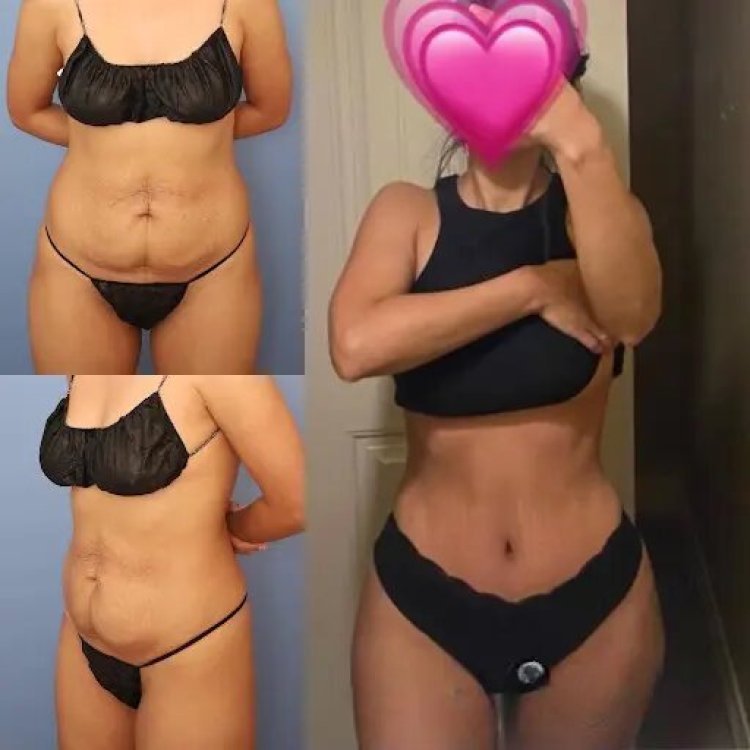 Best Tummy Tuck Surgeons in dubai: Everything You Need to Know
