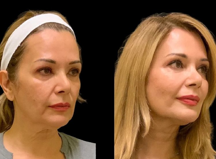 How the Best Doctors in Dubai Deliver Quick and Effective Cheek Fillers Treatments