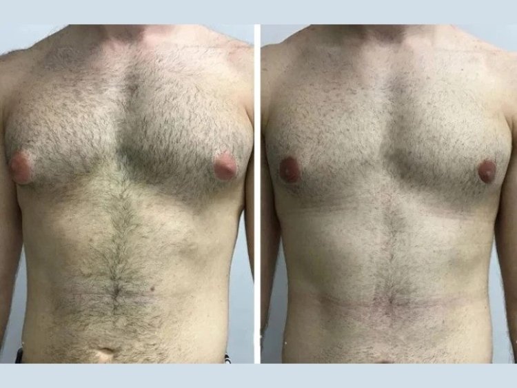 How to Choose the Best Gynecomastia Surgeons in Dubai for Your Needs