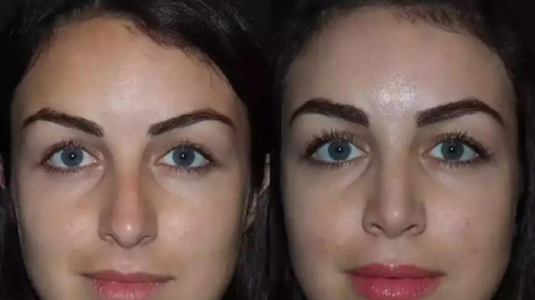 Ethnic Rhinoplasty in Dubai: Respecting and Refining Your Heritage