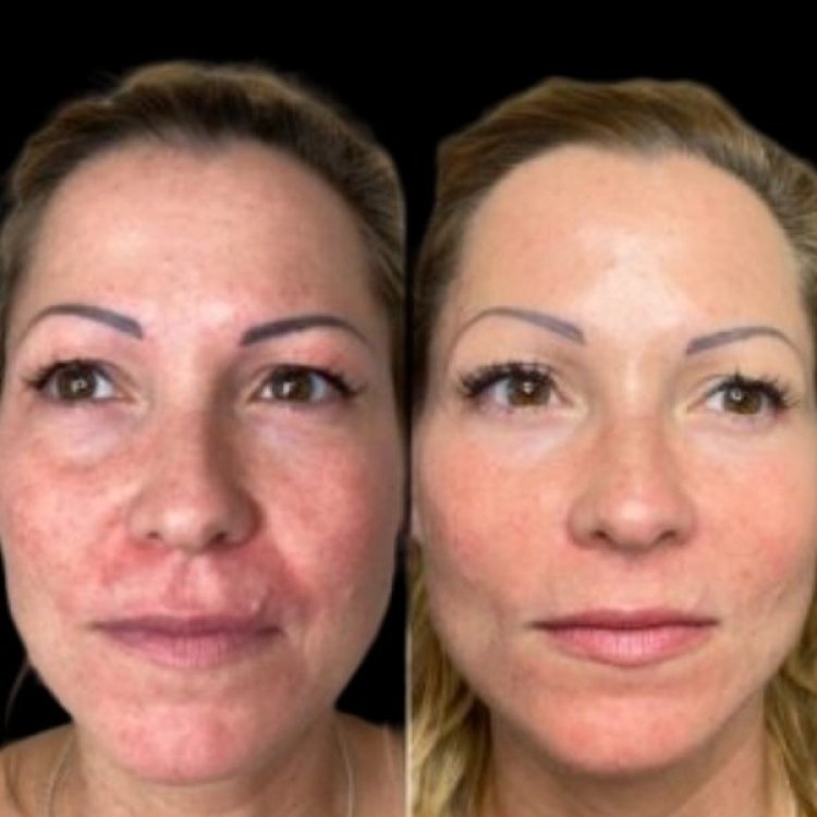 Refresh Skin Goals with Profhilo at Best Aesthetic Clinics in dubai