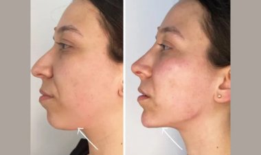 Get Flawless Contours with Endolift from the Best Plastic Surgeon in Dubai