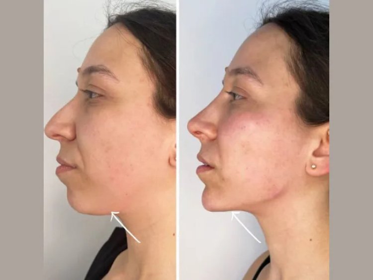 Get Flawless Contours with Endolift from the Best Plastic Surgeon in Dubai