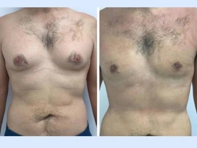 Long-Term Care After Gynecomastia Surgery in Dubai